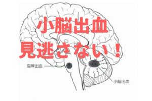 救急車で病院へ行くべきめまい