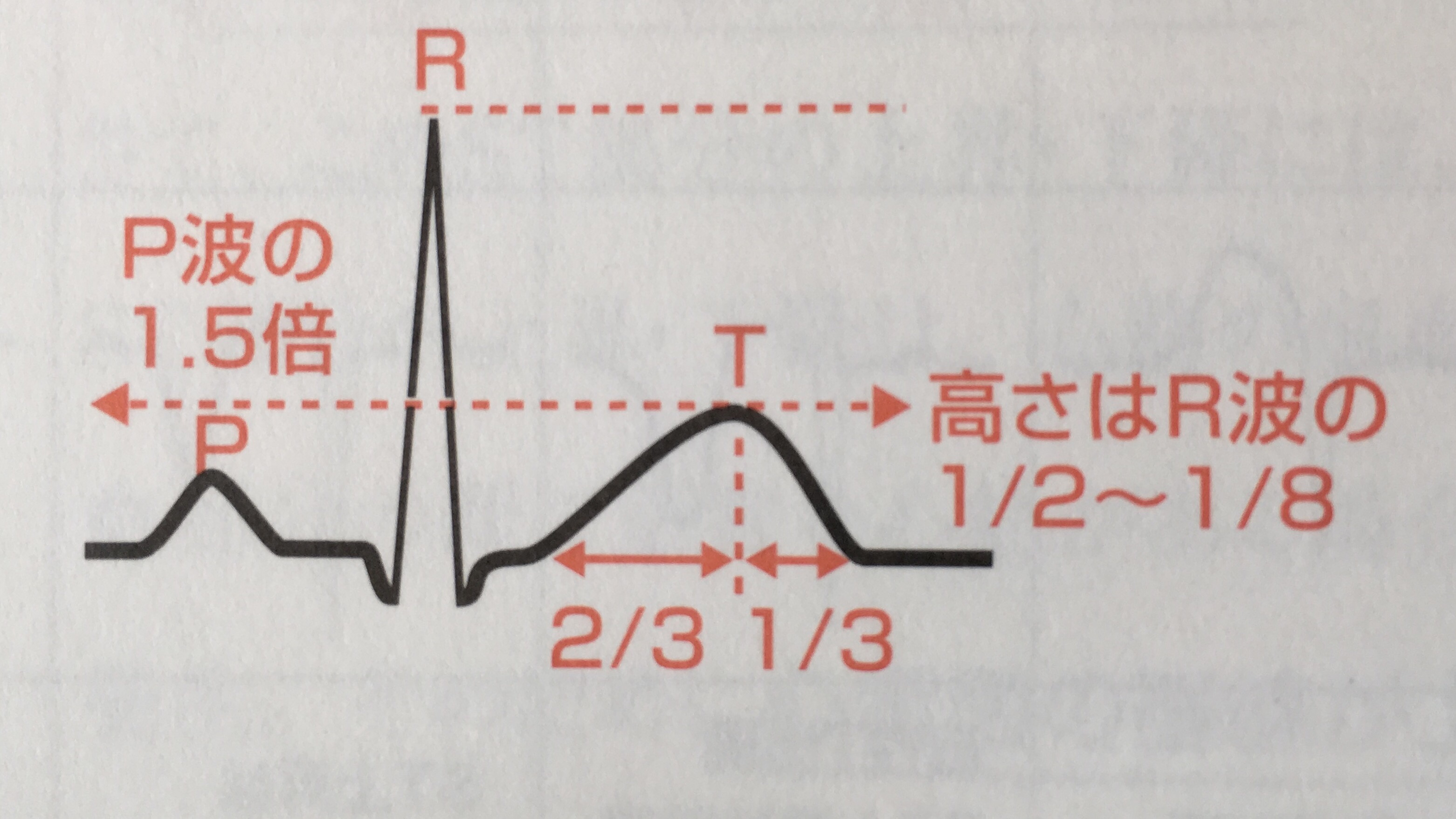 心電図二相性とは – 心電図 二峰性T _ 心電図波形の名称と成り立ち – NXFJO