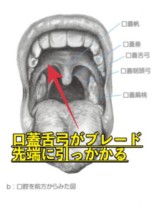 喉頭展開の口蓋舌弓