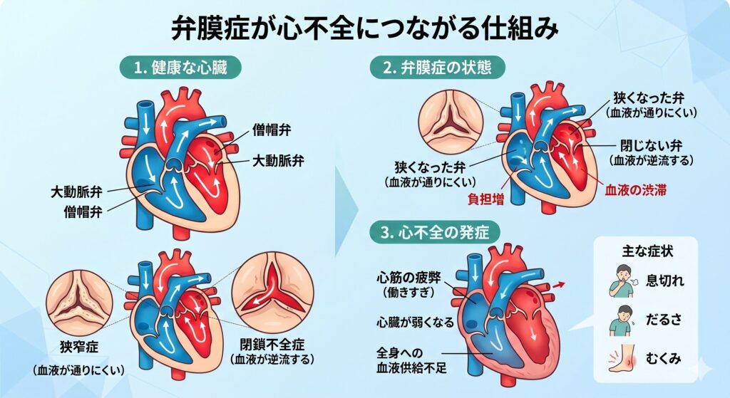弁膜症から心不全になる理由