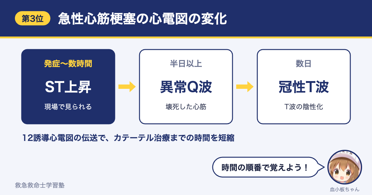 急性心筋梗塞の心電図の時間変化（ST上昇→異常Q波→冠性T波）