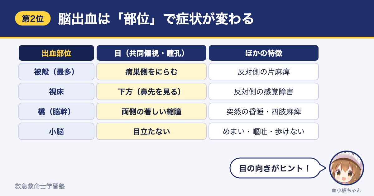 脳出血の部位と症状（被殻・視床・橋・小脳の共同偏視・瞳孔・麻痺の違い）
